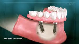 fixed hybrid dentures boco dental