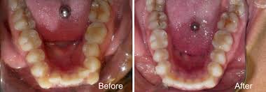 You could have active decay that is in the early stages and may be able to be reversed with professional dental care. When Why You Need Tooth Extraction For Orthodontic Treatment