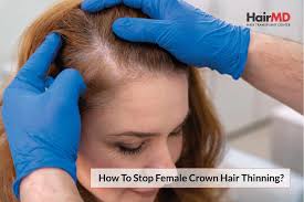 how to stop female crown hair thinning