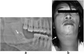 a the pantomography after extraction