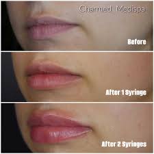lip injections with multiple syringes