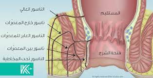 علاج الناسور بدون جراحة