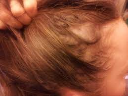 At any given time, most of your hair is growing while only a small portion of it is resting. Hair Loss Since Taking Levothyroxine Heralopecia Forums
