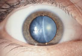 Cataract Causes Symptoms Surgery Complications Happy