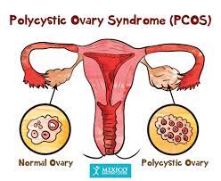 polycystic ovary syndrome pcos