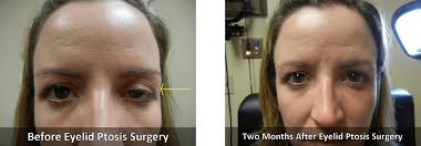 As with any surgical procedure. Ptosis 1 Lasik Eugene Cataract Surgery Eugene Oakridge Eye Care