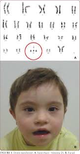 Flat nasal bridge and epicanthal folds : Figure 1 From Intellectual Disability And Epilepsy In Down Syndrome Semantic Scholar