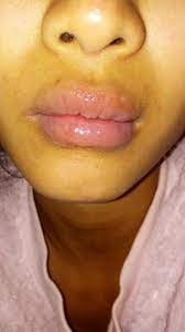 after juvederm lip fillers pus comes