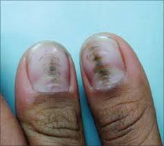 nail tic disorders manifestations