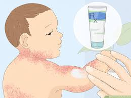 how to treat baby heat rash 11 steps