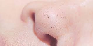 Also, do not overdo it because it will dry the skin. Why You Have Blackheads On Nose Insider