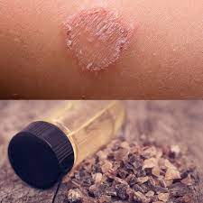 ringworm treatment try these 6 natural