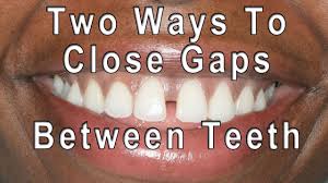 To correct the issue, it's first necessary to consult with an orthodontist, a specialist in bites and tooth alignment. Front Teeth Gap Causes And Treatment Options For Diastema Dentistry Blogs