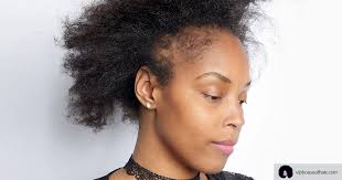Most people only lose hair in small, round patches. What You Need To Know About Alopecia Vip House Of Hair