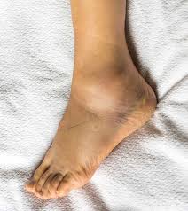 25 remes to treat edema naturally