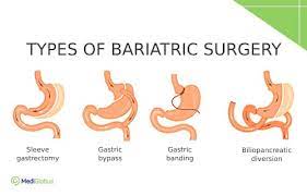 16 questions about bariatric surgery