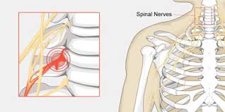 pinched nerve in the neck treatment nyc