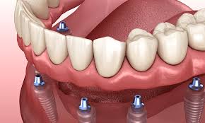 a new look to dental implants cost
