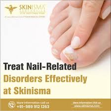 nail disorders treatment in delhi