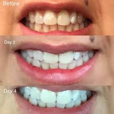 It is very important to know how to discolored teeth result from intrinsic and extrinsic factors that include age, genetics, smoking, health, allergies, poor oral hygiene and. 20 Teeth Whiteners That Work So Well It S Like Magic
