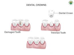Check spelling or type a new query. Low Cost Dental Crowns Abroad Same Day Crowns Best Quality