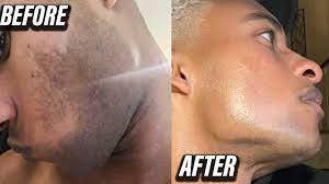 laser hair removal for men s beard