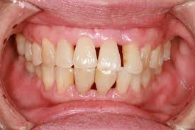 Periodontitis is a gum infection that damages the soft tissue and bone that supports the tooth. Periodontitis Treatment Home Remedies And Symptoms