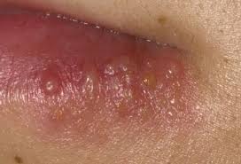 Symptoms early symptoms tend to happen around 2 to 12 days after infection. Herpes Simplex Virus Type 1 Picture Image On Medicinenet Com