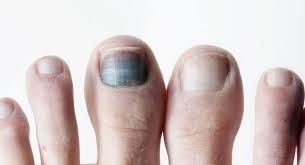 discoloured toenails foot specialist