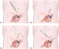 jejunostomy an overview