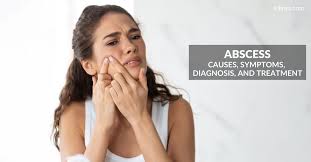 abscess causes symptoms treatment