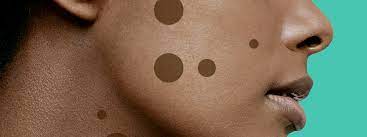 9 dark spot treatments that really work