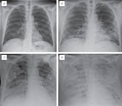 Chest radiographs are the most common film taken in medicine. Overview Of Current Lung Imaging In Acute Respiratory Distress Syndrome European Respiratory Society
