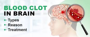 blood clot in brain types reason