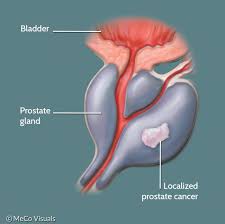 Prostate cancer is one of the most common types of cancer diagnosed in men. What Is Localized Or Locally Advanced Prostate Cancer Pcf