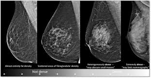 Confusion About Breast Density The Austin Diagnostic Clinic