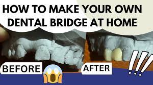 make your own dental bridge at home diy