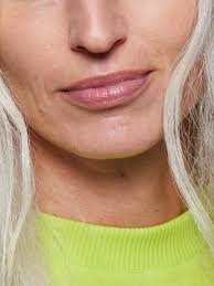 how to get rid of lip lines according