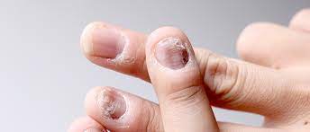 nail fungus