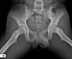 1 day for the external anatomy 1 day for the digestive and then a third day where students can optionally remove the brain and leg bones. Pediatric Hip Frog Leg Lateral View Radiology Reference Article Radiopaedia Org
