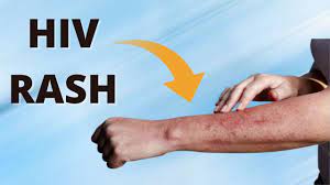how to identify an hiv rash you