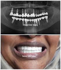 full mouth dental implants full mouth