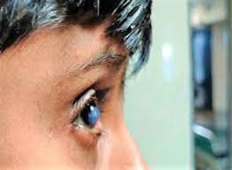 allergic eye disease and keratoconus