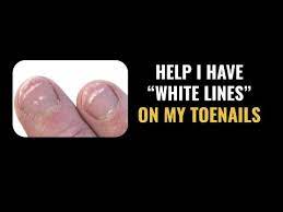 white lines toenails know why you have