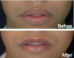 lip reduction surgery in la