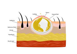 abscess drainage palmer general