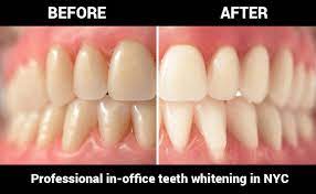 illegal teeth whitening treatments on