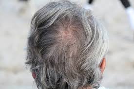 what causes gray hair disabled world