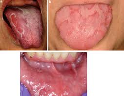 red lesions of the mucosa