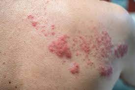 shingles signs and symptoms